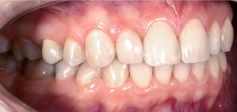 Скученность - Кейс 15 — боковой ракурс после лечения