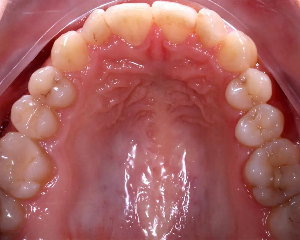 Скученность - Кейс 15 — верхняя челюсть до лечения