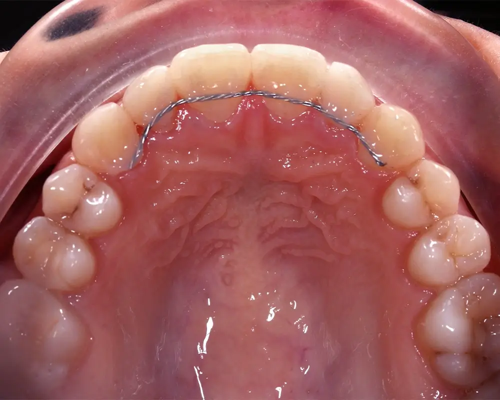 Скученность - Кейс 15 — верхняя челюсть после лечения