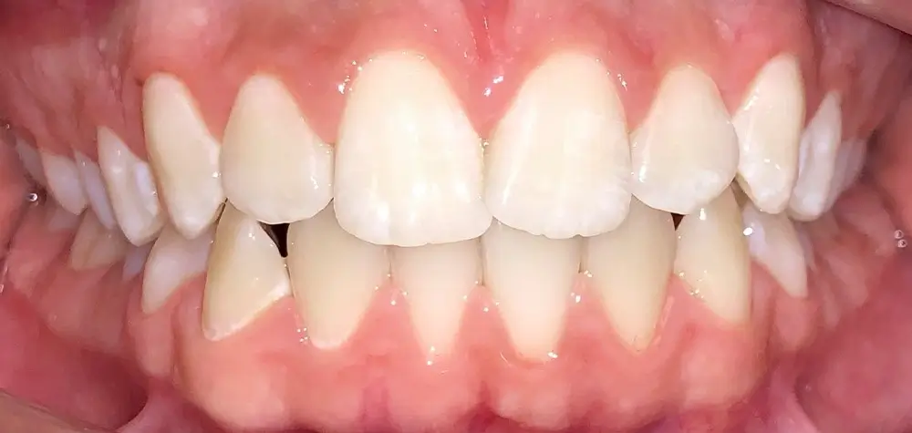 Скученность - Кейс 16 — вид спереди до лечения