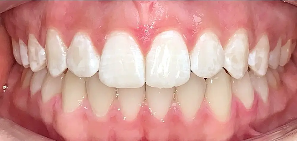 Скученность - Кейс 16 — вид спереди после лечения