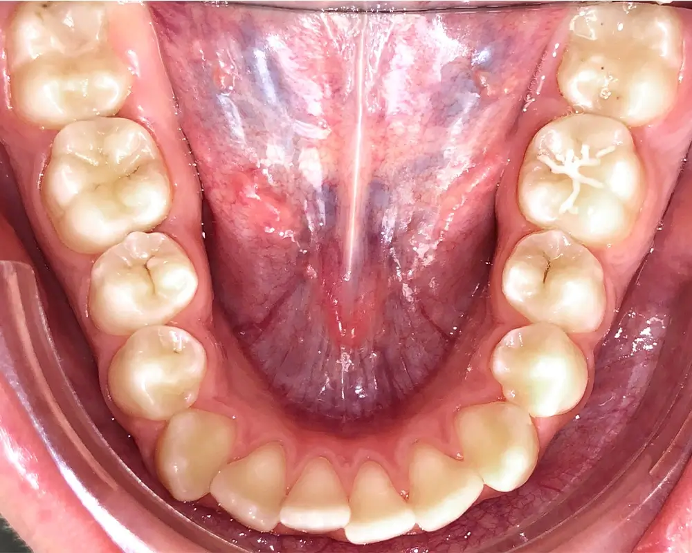 Скученность - Кейс 16 — нижняя челюсть до лечения