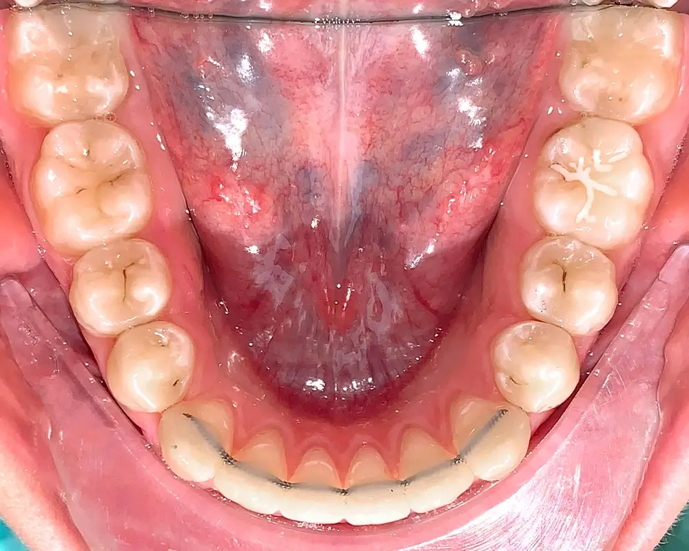Скученность - Кейс 16 — нижняя челюсть после лечения