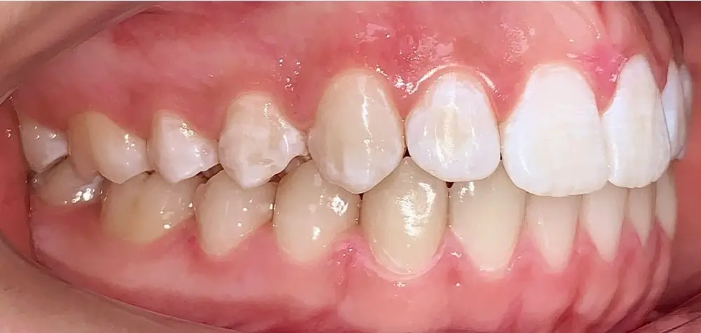 Скученность - Кейс 16 — боковой ракурс после лечения