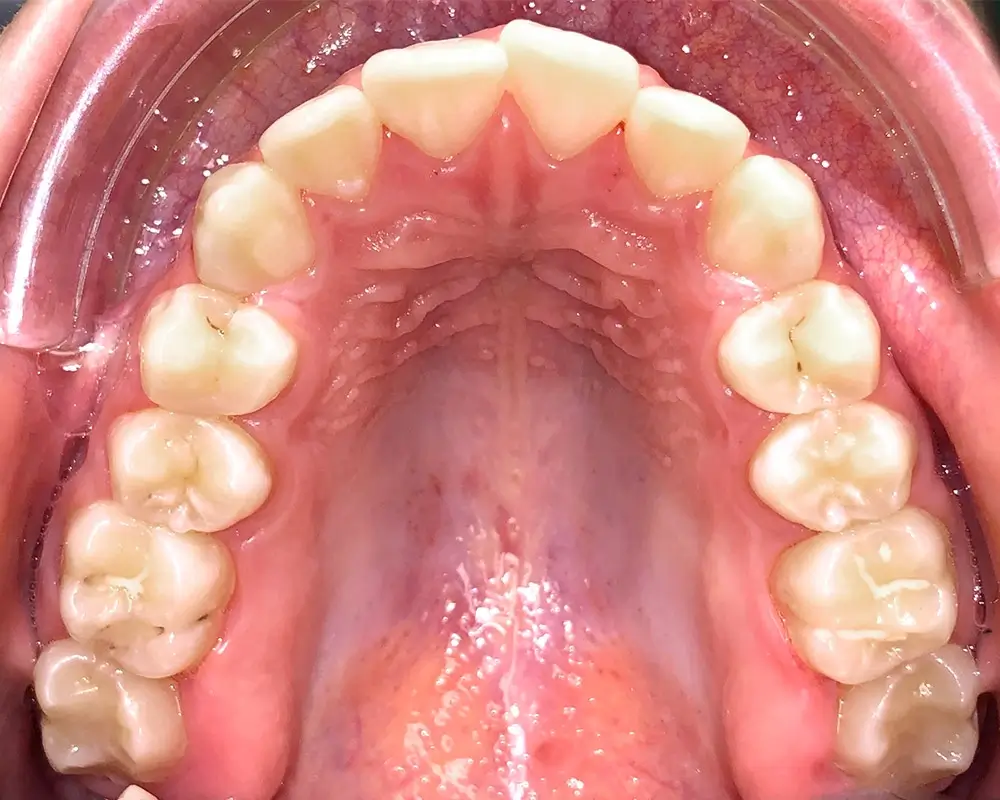 Скученность - Кейс 16 — верхняя челюсть до лечения
