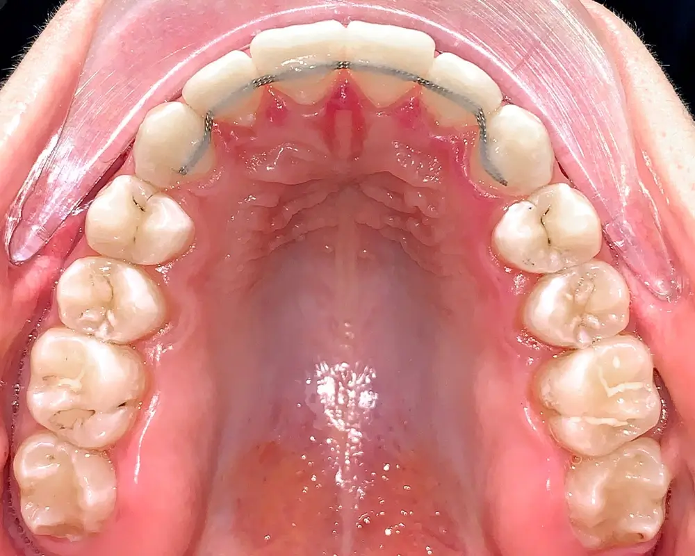 Скученность - Кейс 16 — верхняя челюсть после лечения