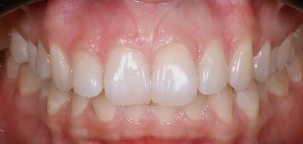 Скученность - Кейс 17 — вид спереди до лечения