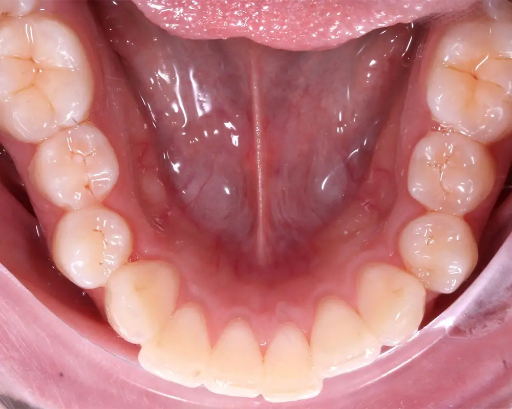 Скученность - Кейс 17 — нижняя челюсть до лечения