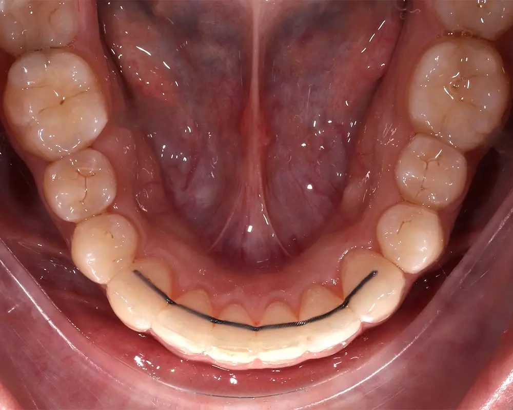 Скученность - Кейс 17 — нижняя челюсть после лечения