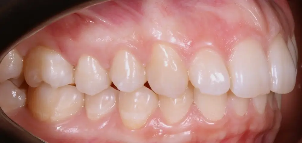 Скученность - Кейс 17 — боковой ракурс до лечения