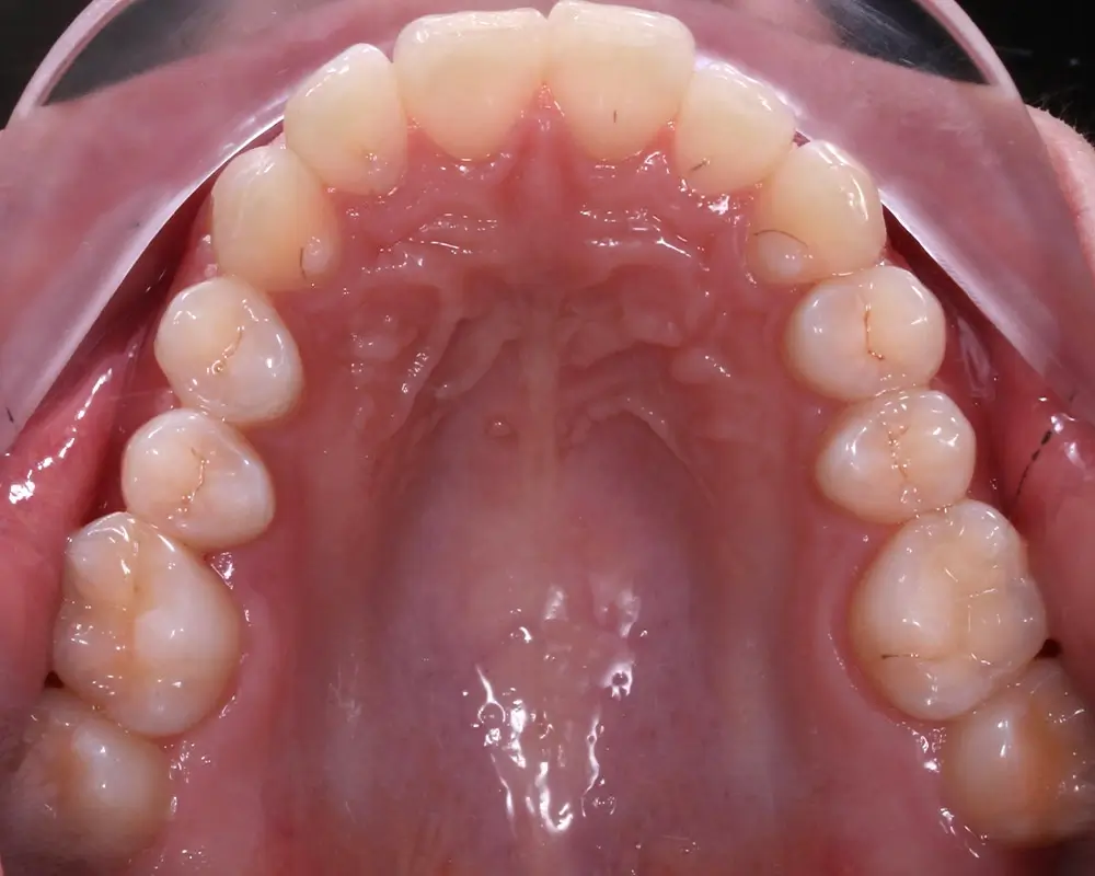 Скученность - Кейс 17 — верхняя челюсть до лечения