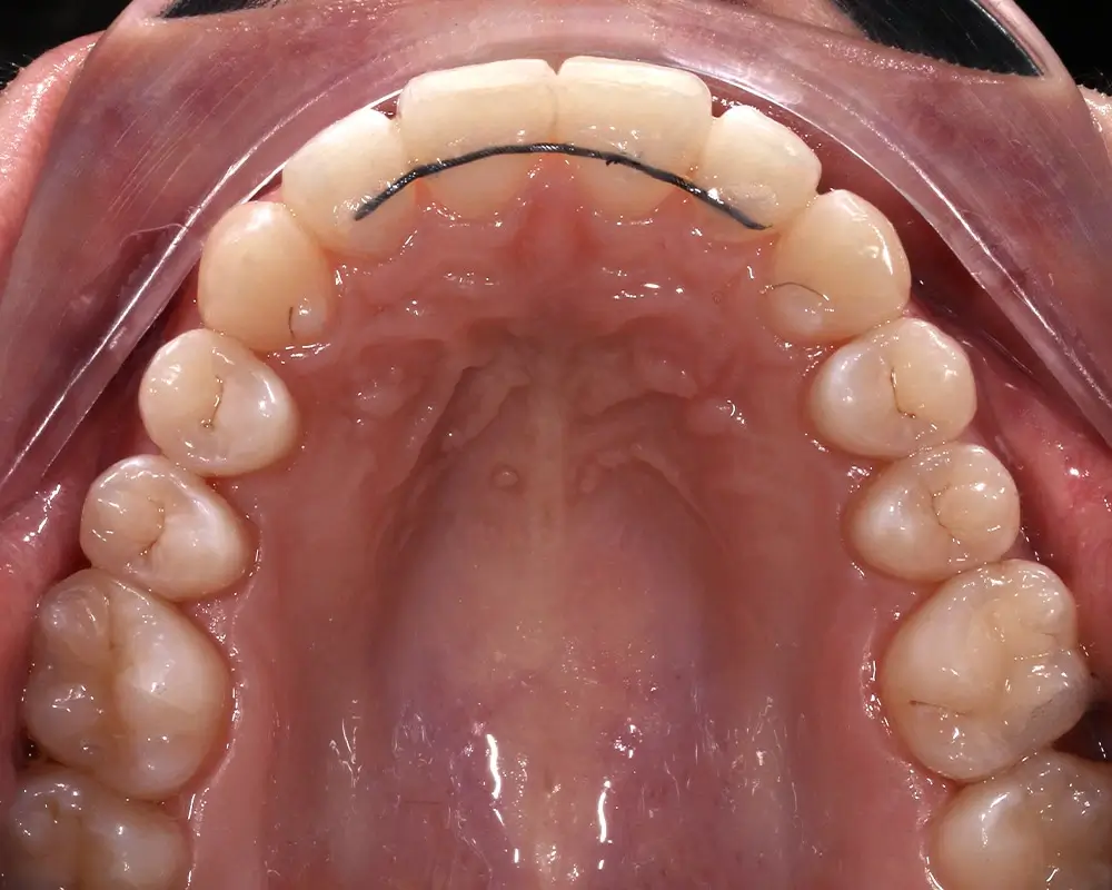 Скученность - Кейс 17 — верхняя челюсть после лечения