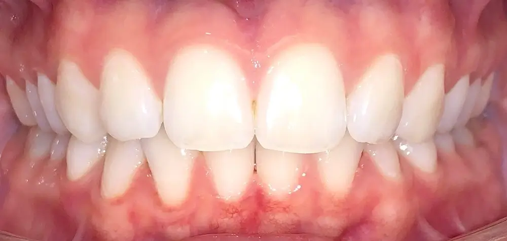 Скученность - Кейс 18 — вид спереди до лечения