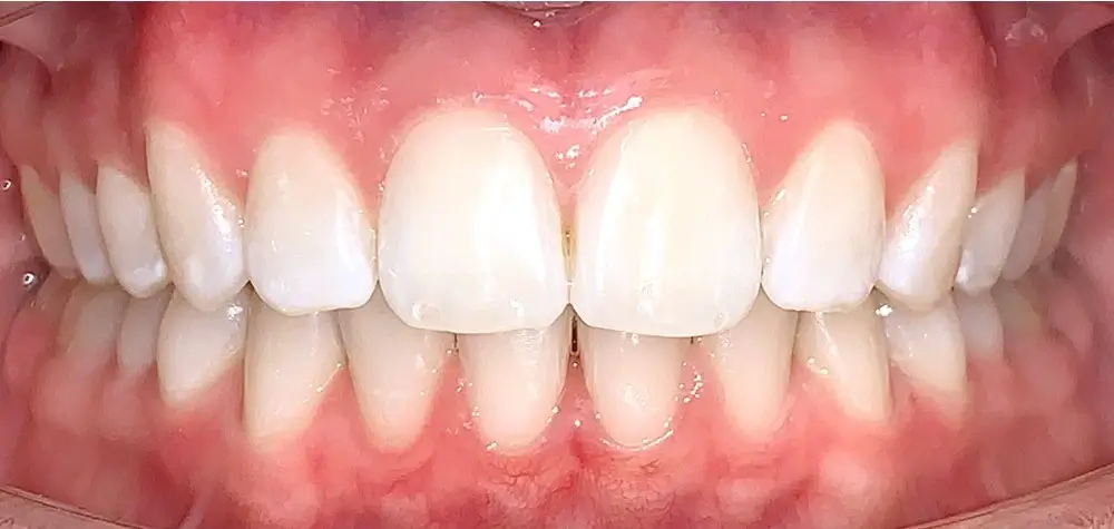 Скученность - Кейс 18 — вид спереди после лечения