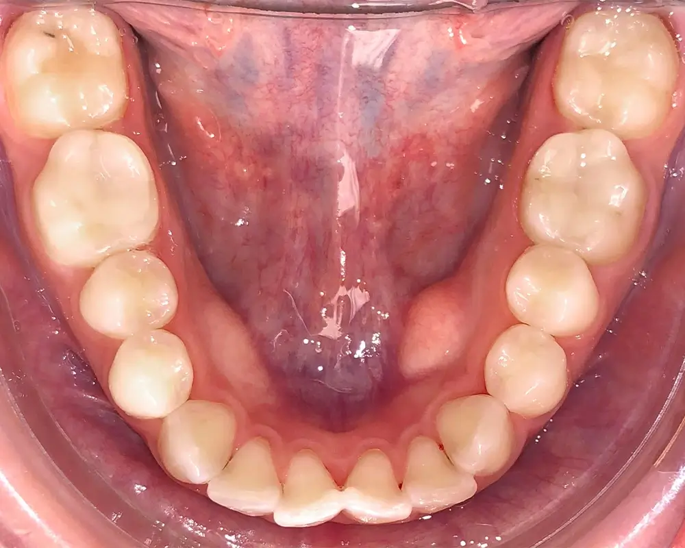 Скученность - Кейс 18 — нижняя челюсть до лечения
