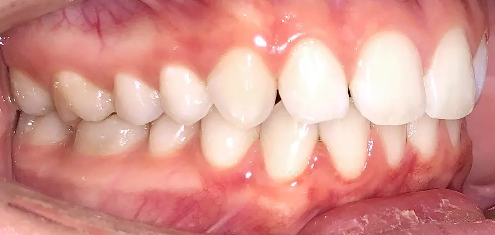 Скученность - Кейс 18 — боковой ракурс до лечения