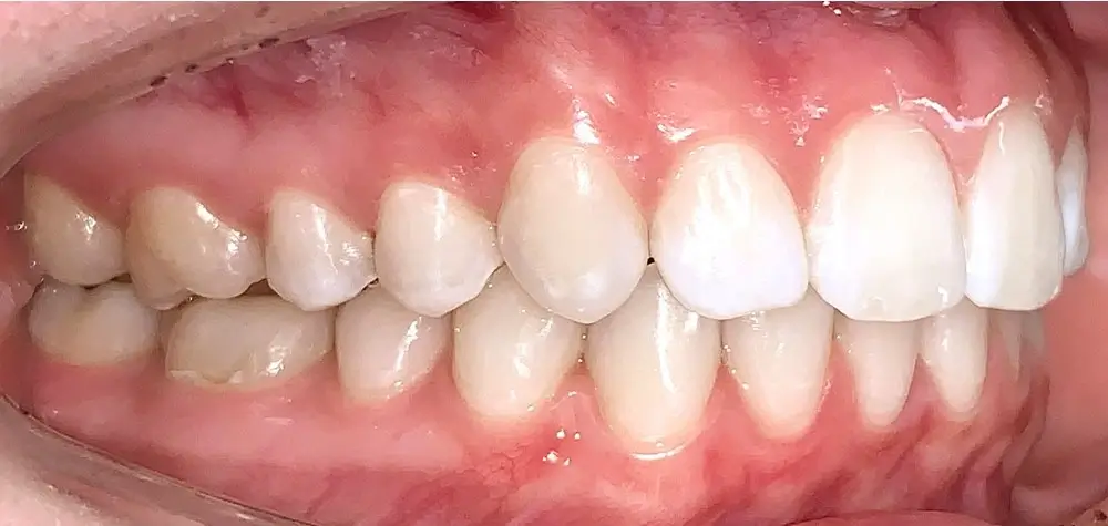 Скученность - Кейс 18 — боковой ракурс после лечения