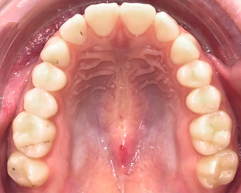 Скученность - Кейс 18 — верхняя челюсть до лечения