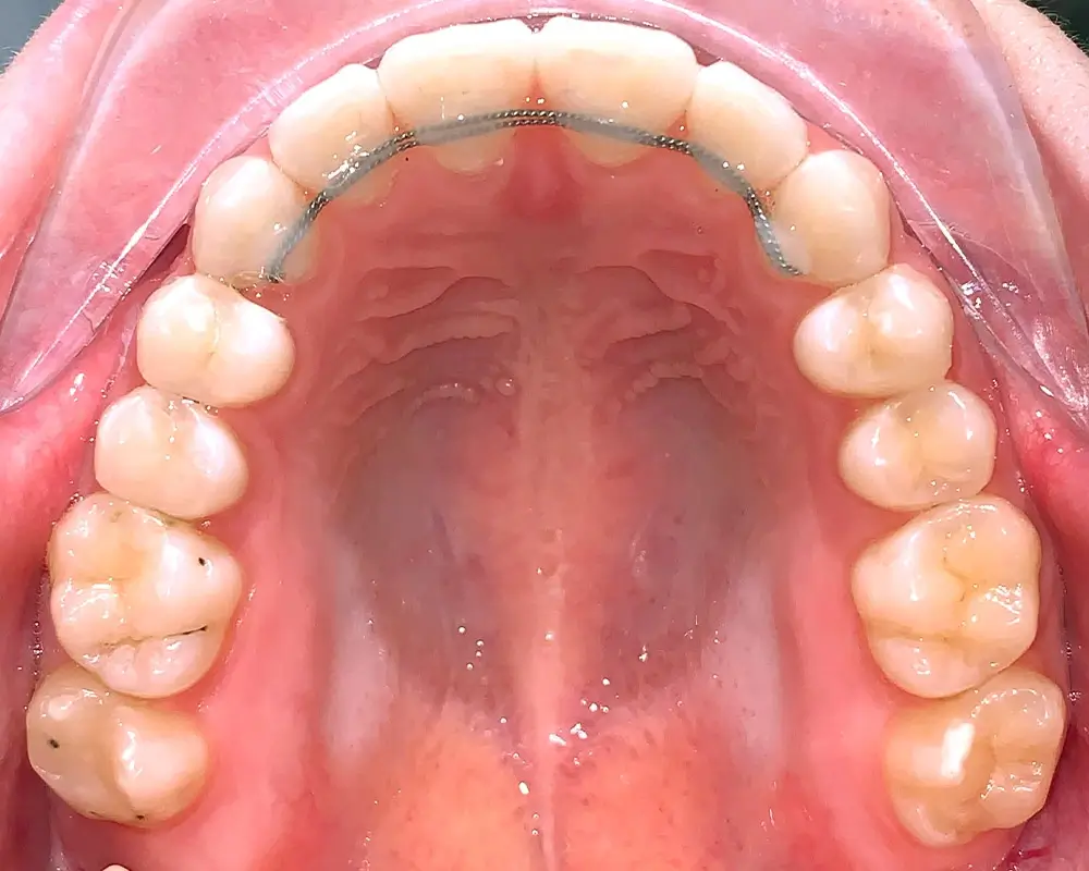 Скученность - Кейс 18 — верхняя челюсть после лечения