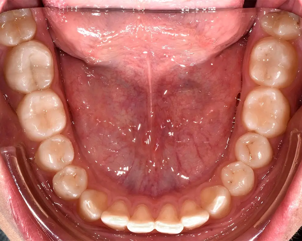Скученность - Кейс 19 — нижняя челюсть до лечения