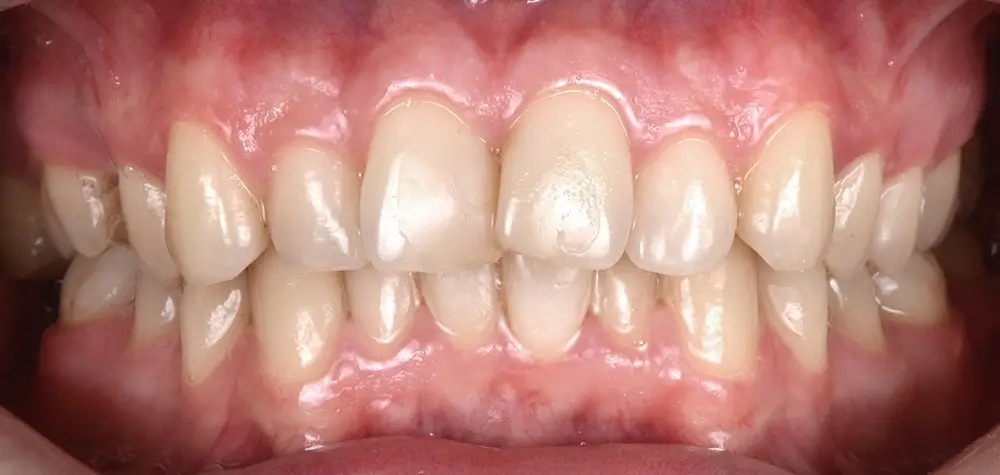 Скученность - Кейс 2 — вид спереди до лечения