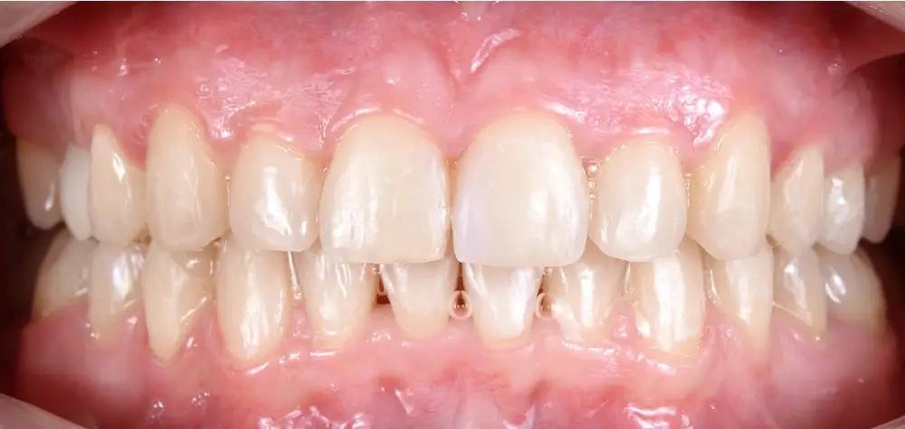 Скученность - Кейс 2 — вид спереди после лечения