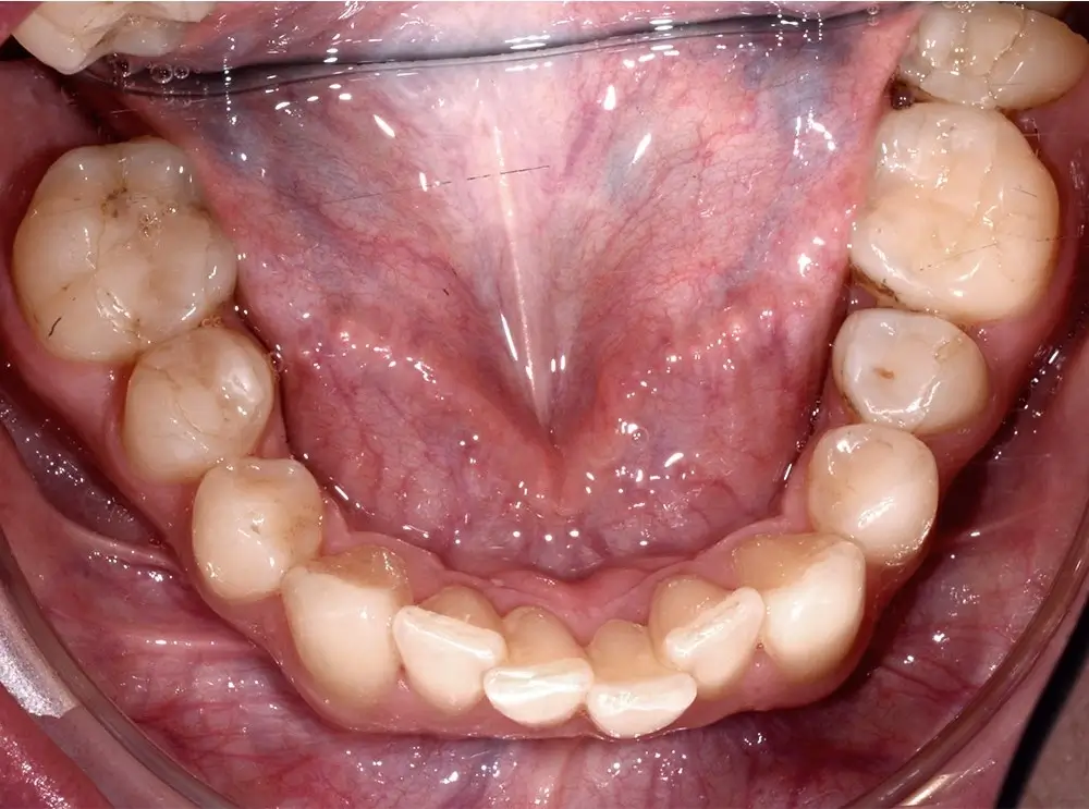 Скученность - Кейс 2 — нижняя челюсть до лечения