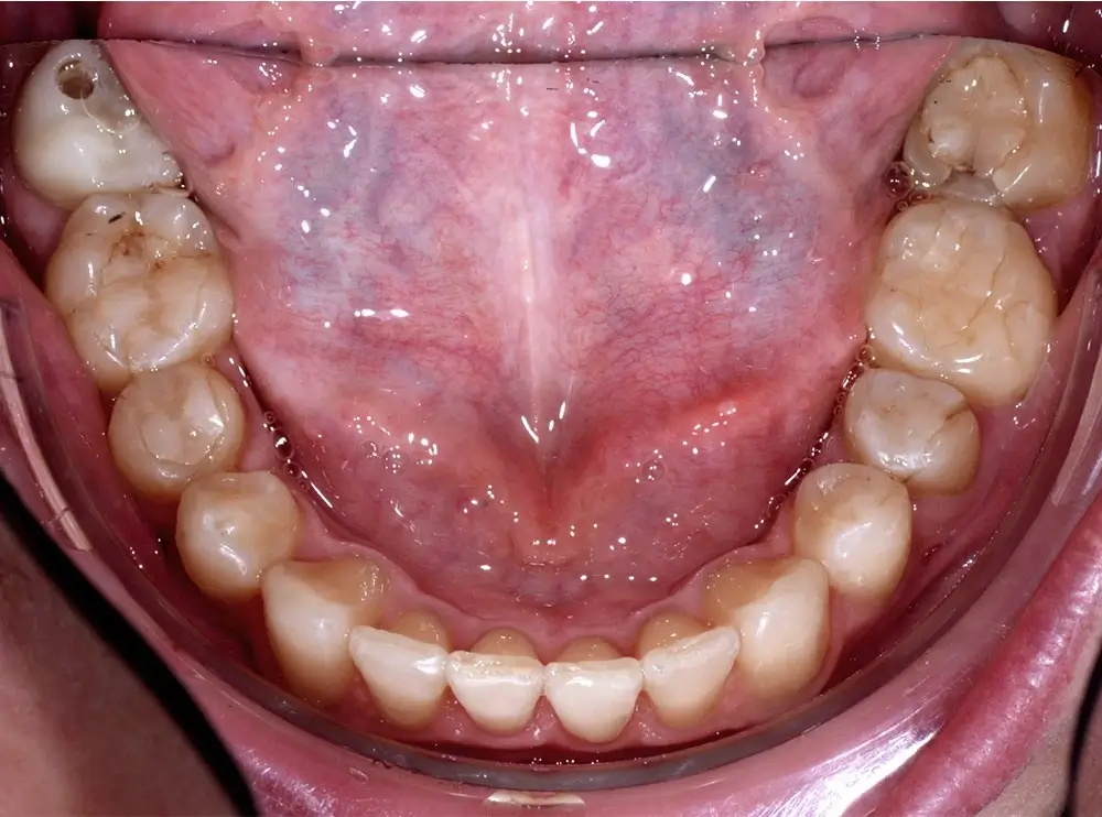 Скученность - Кейс 2 — нижняя челюсть после лечения