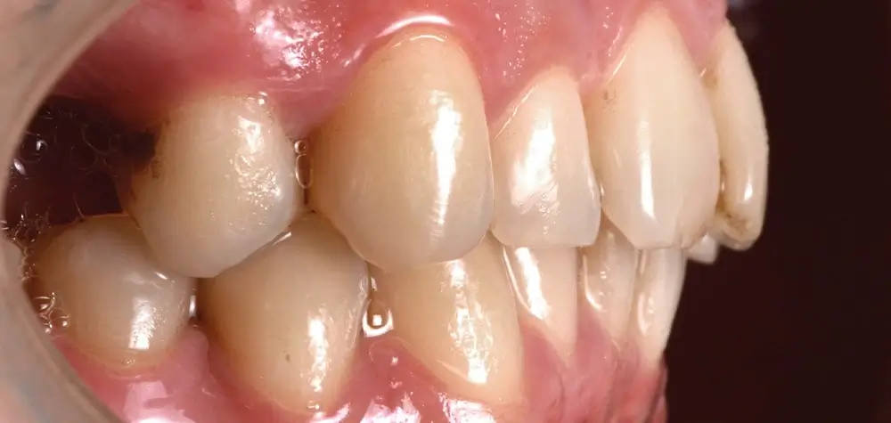 Скученность - Кейс 2 — боковой ракурс до лечения