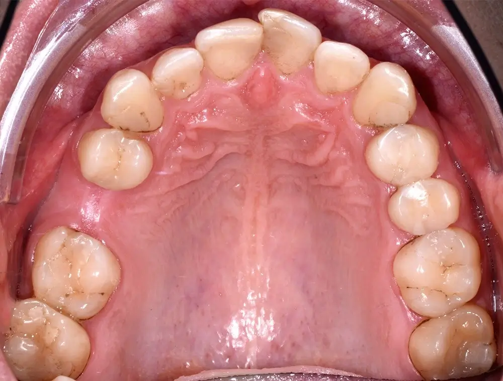 Скученность - Кейс 2 — верхняя челюсть до лечения