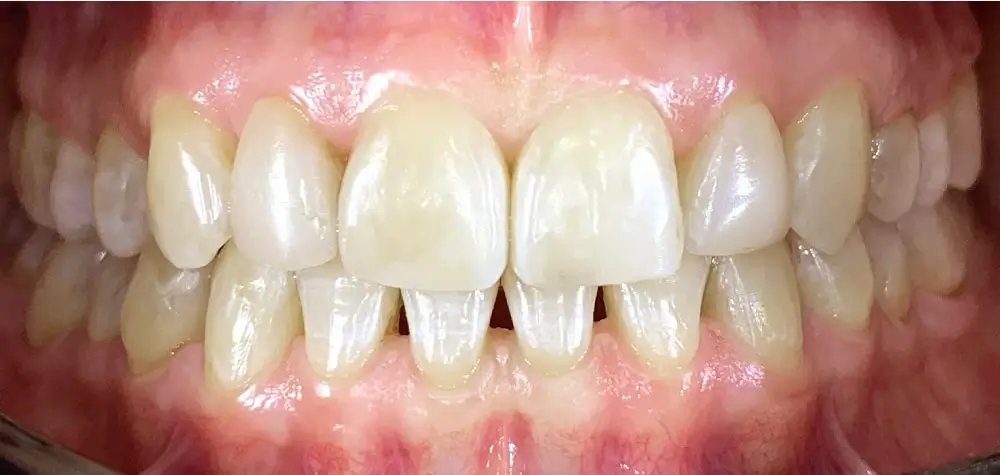 Скученность - Кейс 20 — вид спереди после лечения