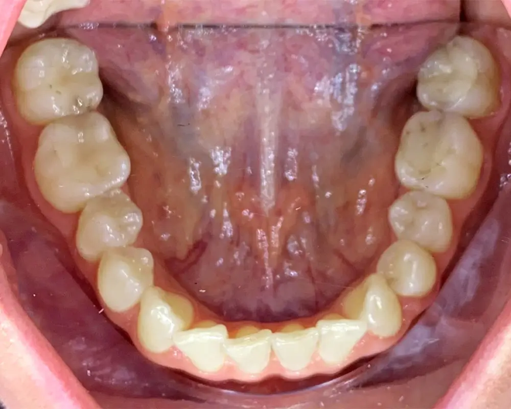 Скученность - Кейс 20 — нижняя челюсть до лечения