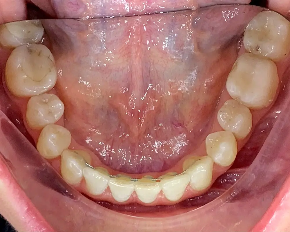 Скученность - Кейс 20 — нижняя челюсть после лечения