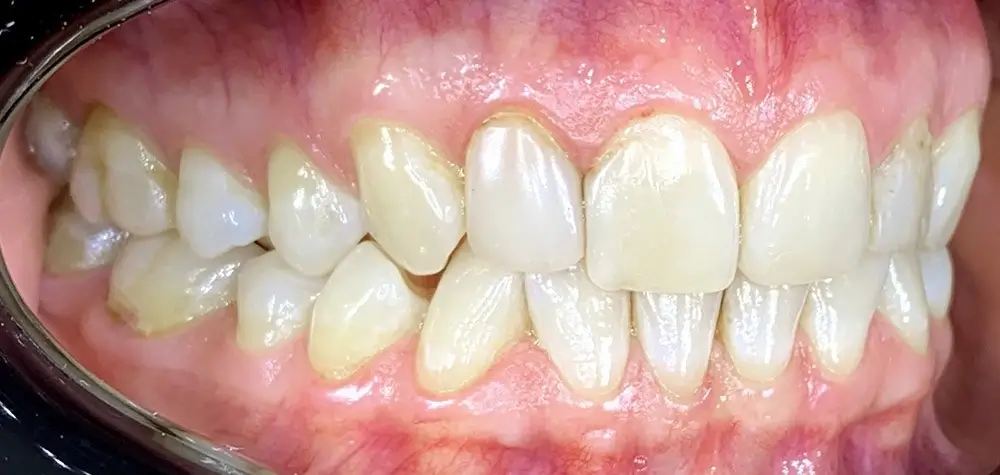 Скученность - Кейс 20 — боковой ракурс до лечения