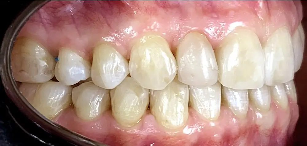 Скученность - Кейс 20 — боковой ракурс после лечения