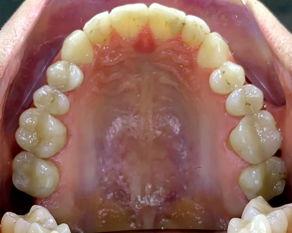 Скученность - Кейс 20 — верхняя челюсть до лечения