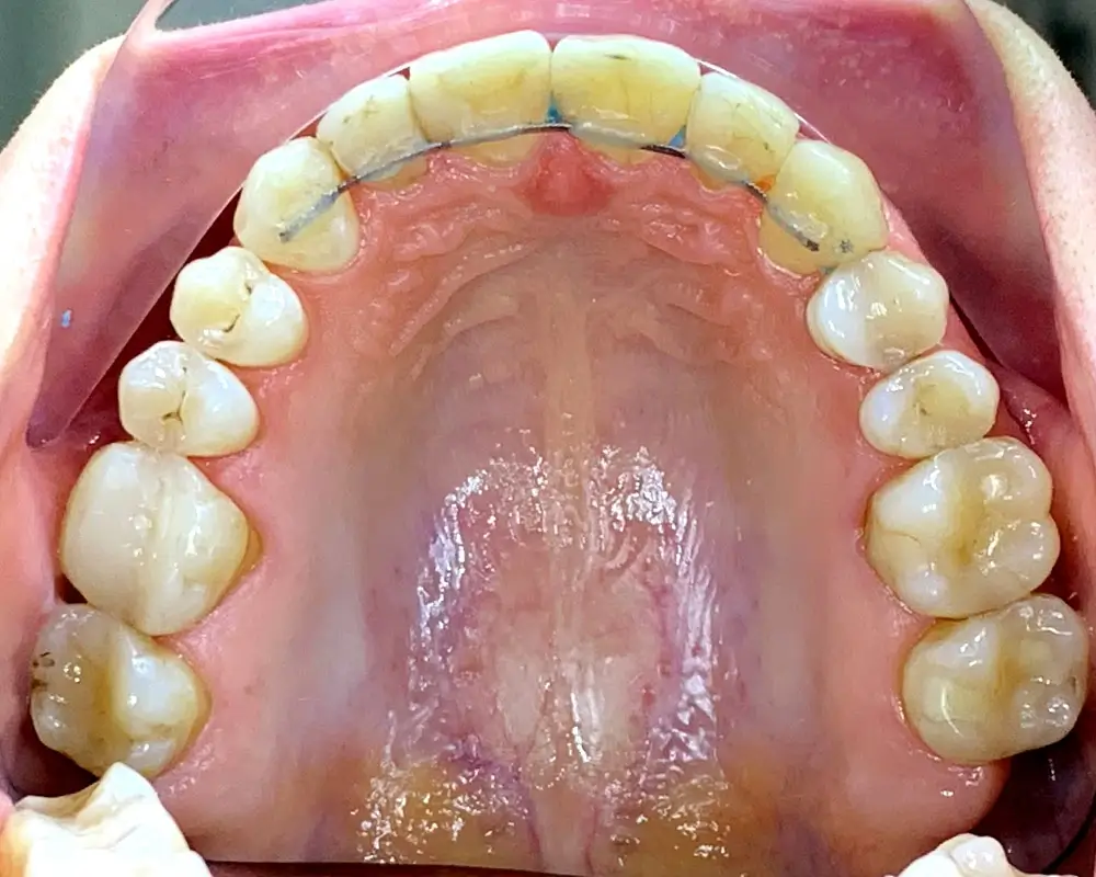 Скученность - Кейс 20 — верхняя челюсть после лечения