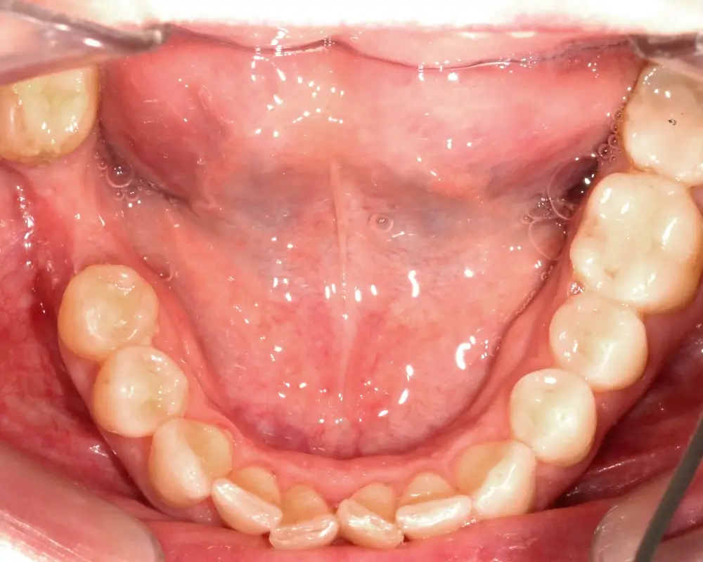Скученность - Кейс 21 — нижняя челюсть до лечения
