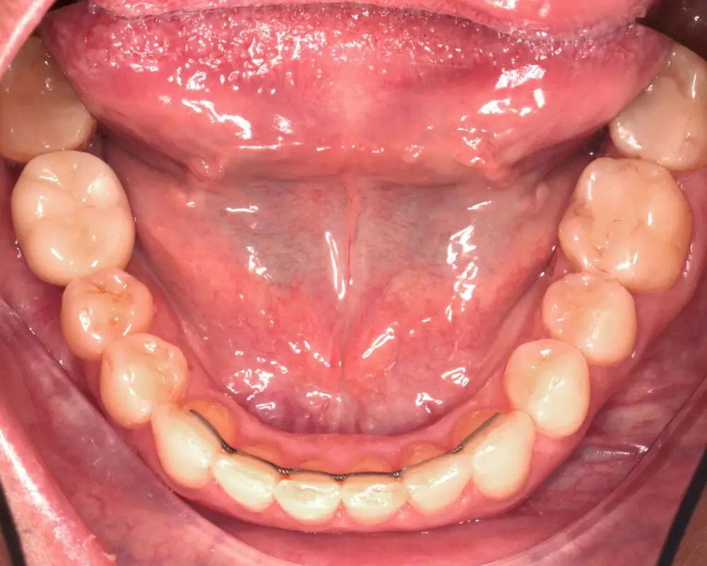 Скученность - Кейс 21 — нижняя челюсть после лечения