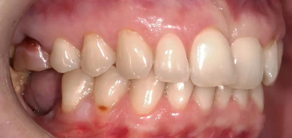 Скученность - Кейс 21 — боковой ракурс до лечения