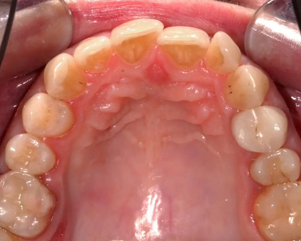 Скученность - Кейс 21 — верхняя челюсть до лечения