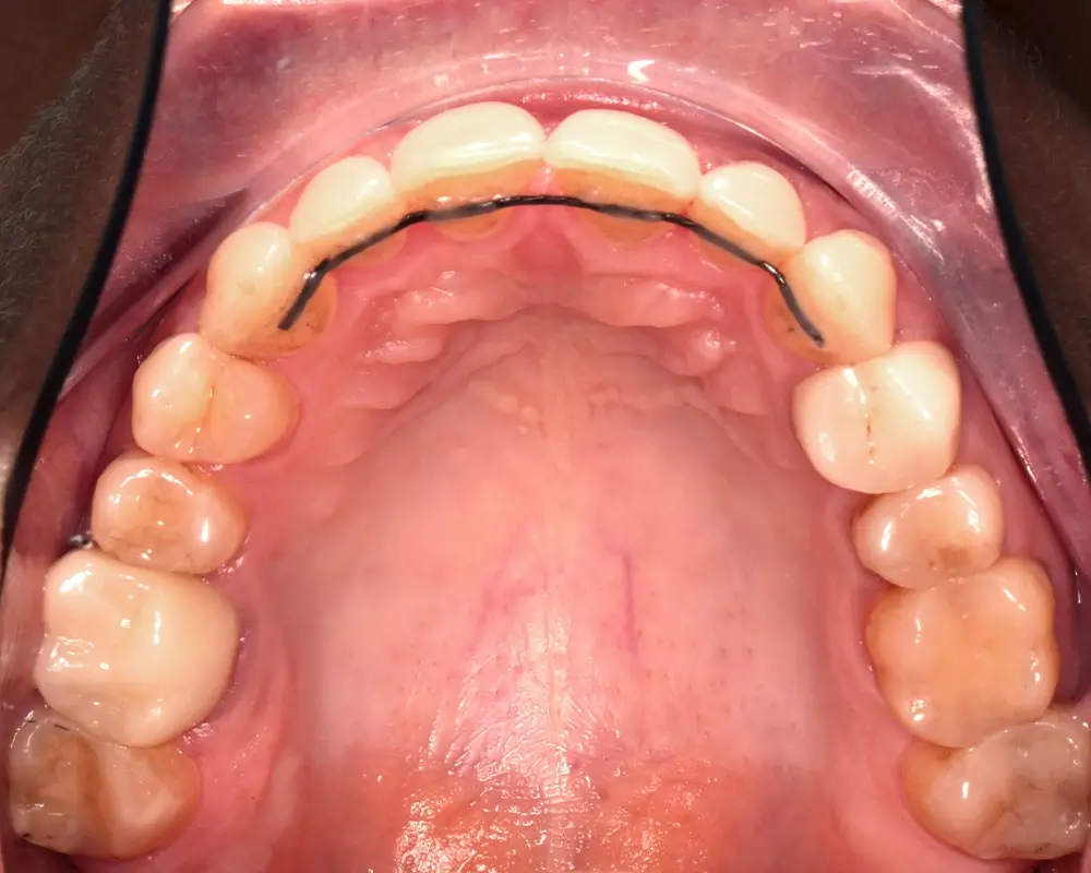 Скученность - Кейс 21 — верхняя челюсть после лечения