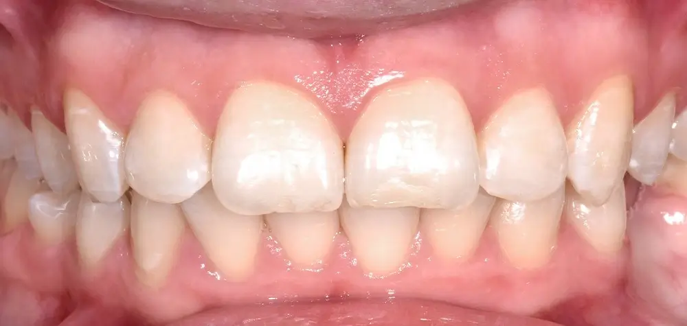 Скученность - Кейс 22 — вид спереди до лечения