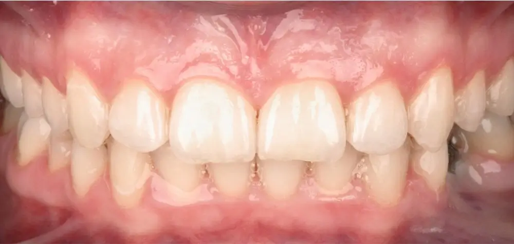 Скученность - Кейс 22 — вид спереди после лечения