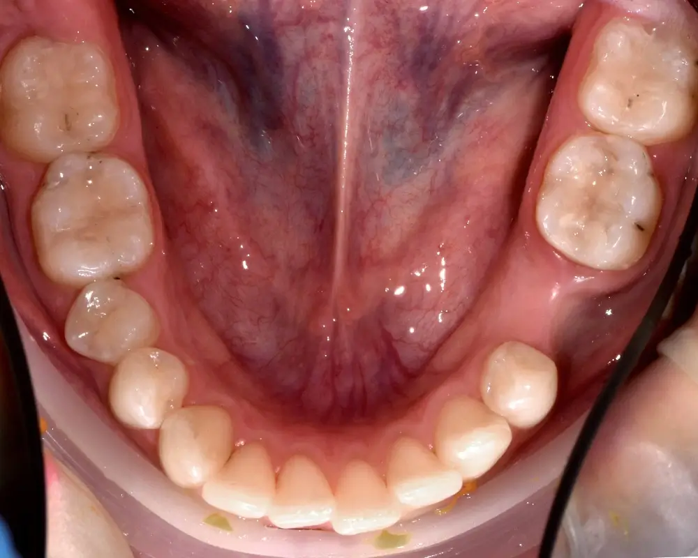 Скученность - Кейс 22 — нижняя челюсть до лечения