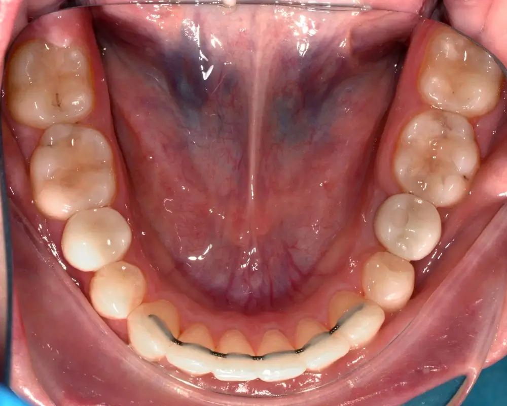 Скученность - Кейс 22 — нижняя челюсть после лечения