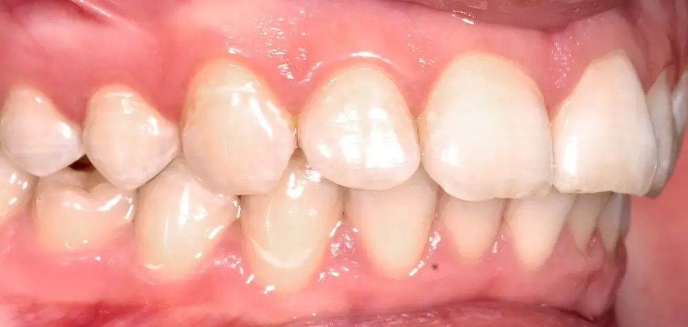 Скученность - Кейс 22 — боковой ракурс до лечения