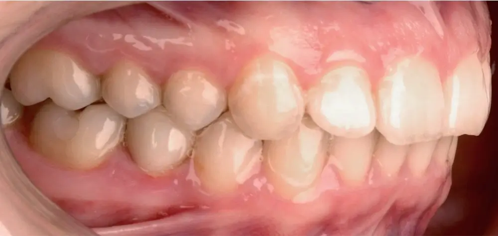 Скученность - Кейс 22 — боковой ракурс после лечения