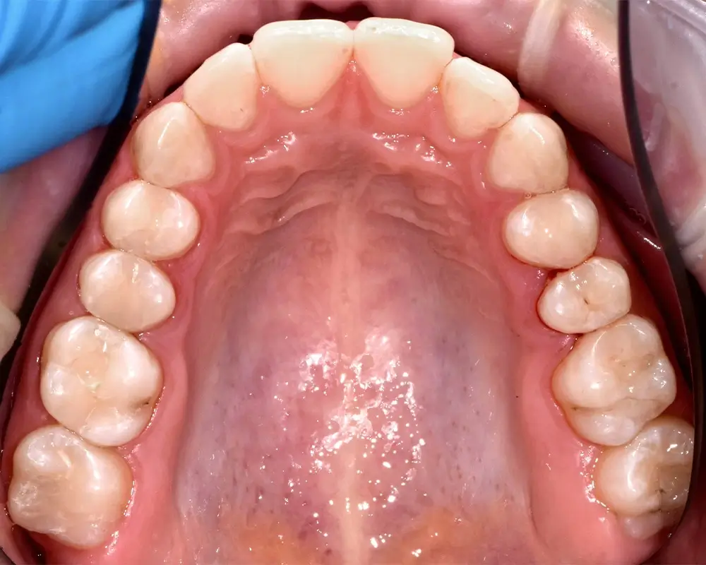 Скученность - Кейс 22 — верхняя челюсть до лечения