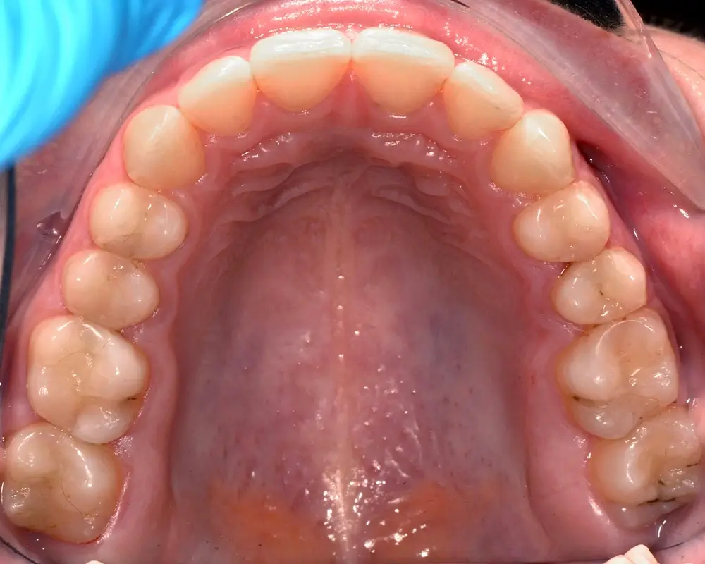 Скученность - Кейс 22 — верхняя челюсть после лечения